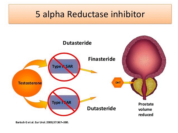 Cơ chế tác dụng của thuốc ức chế 5-Alpha Reductase (5-ARI)