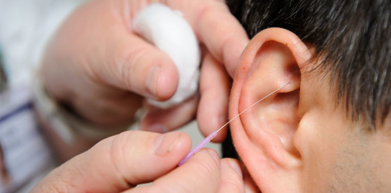Châm cứu tai cần được thực hiện bởi người có chuyên môn