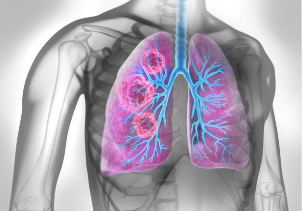 Ung thư phổi được phân làm hai loại
