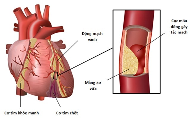 Các bệnh về tim đồng mắc phải với bệnh phổi tắc nghẽn mãn tính ...