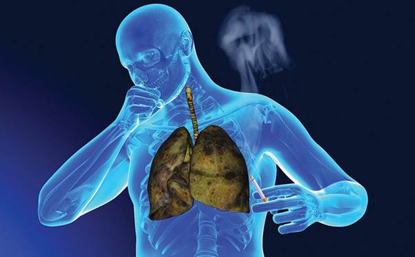 7 dấu hiệu của ung thư phổi bạn cần biết