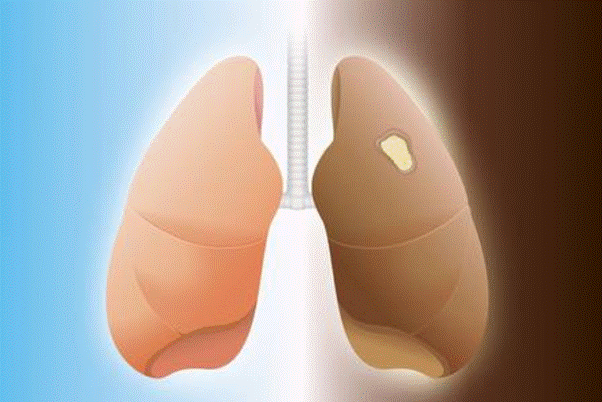 Nhiễm độc phổi là con đường dẫn đến ung thư phổi