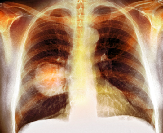 Ung thư phổi là một trong những biến chứng nguy hiểm của viêm phế quản mạn
