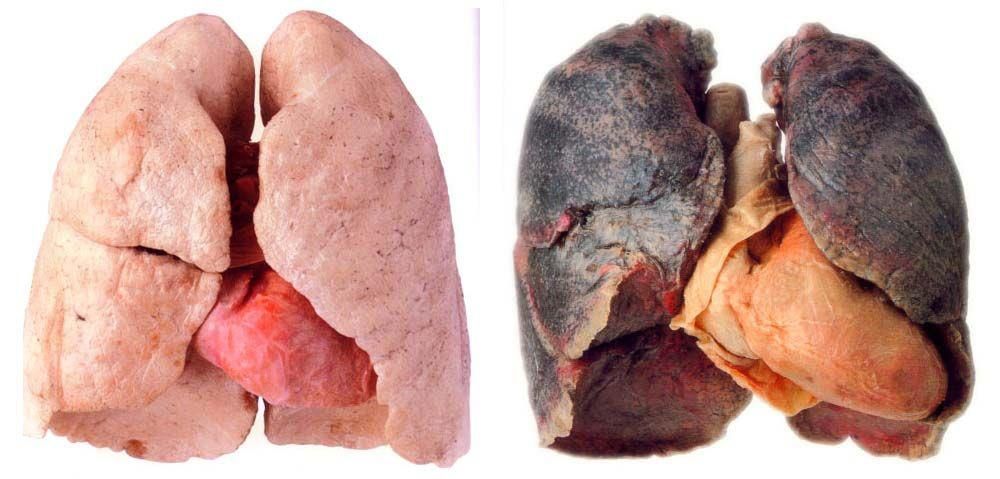 Phổi bình thường và phổi của người hút thuốc lá