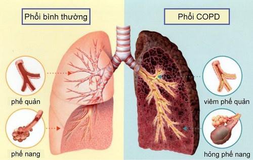 Người thường xuyên hút thuốc lá có nên phòng ngừa bệnh phổi tắc nghẽn mãn tính COPD bằng BoniDetox