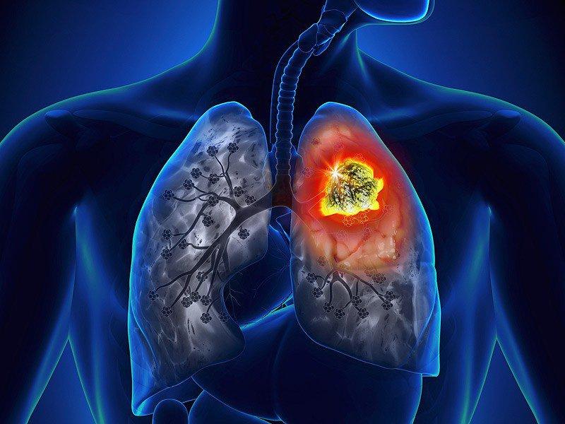 Biến chứng ung thư phổi của bệnh phổi tắc nghẽn mãn tính
