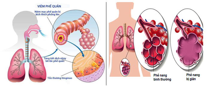 Hai dạng bệnh của phổi tắc nghẽn mãn tính (COPD)