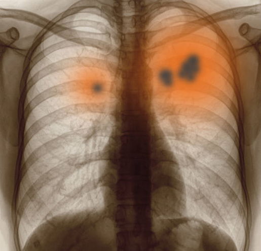 Bệnh bụi phổi silic là gì? Triệu chứng và cách khắc phục ra sao?