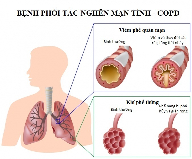 Mối liên quan giữa viêm phế quản mãn tính và bệnh phổi tắc nghẽn mạn tính COPD