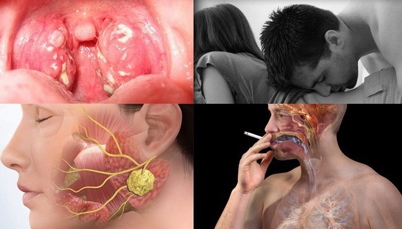 Ung thư vòm họng và một số nguyên nhân gây bệnh