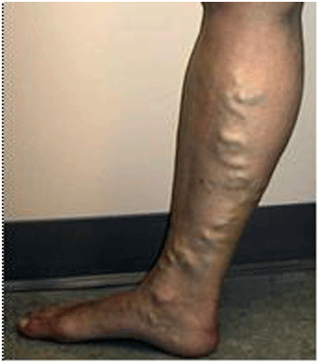 Nổi gân bắp chân, dấu hiệu suy tĩnh mạch chi